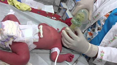 Intubación Neonatal Youtube