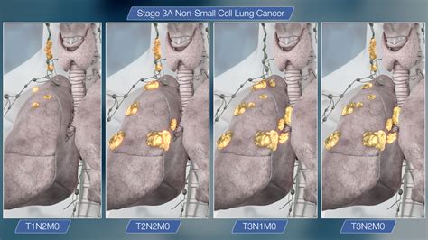 Lung Cancer Survival Rate Non Small Cell Stage 3 Lung Cancer All That
