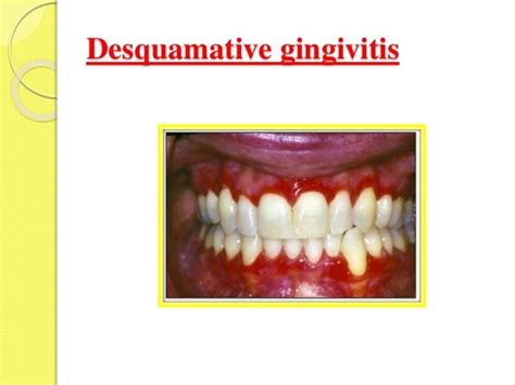 Desquamative Gingivitis Diagnosis And Management