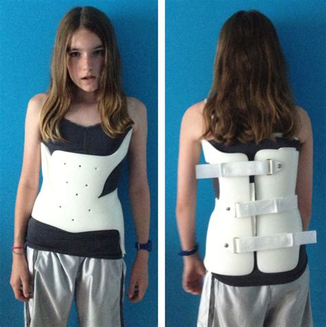 Scoliosis Adults And Children Causes Treatment Brace Exercise