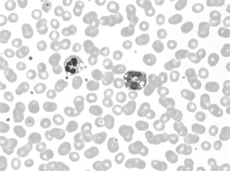 Peripheral Blood Smear Showing Vacuoles In The Neutrophils And