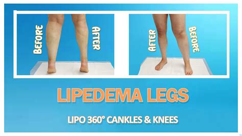 Lipedema Liposuction Lipo Cankles Knees Expert Dr Thomas Su Youtube