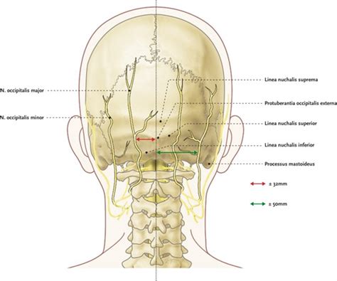 Procedure Nervus Occipitalis Majorminor Injectie Universitair Pijn