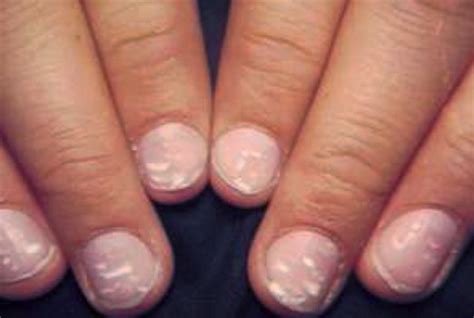 White Spots On Nails Pictures Causes Treatment 2018 Updated