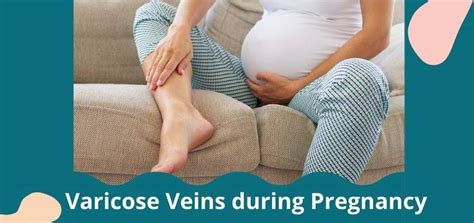 Varicose Veins During Pregnancy All You Need To Know Fabmoms