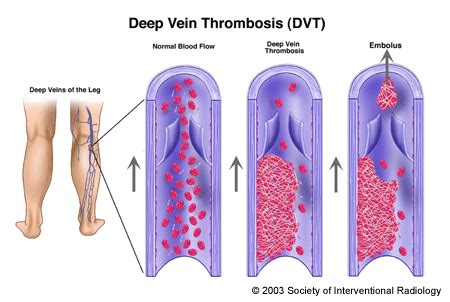 Deep Vein Thrombosis Dvt Floridainterventionalspecialists Com