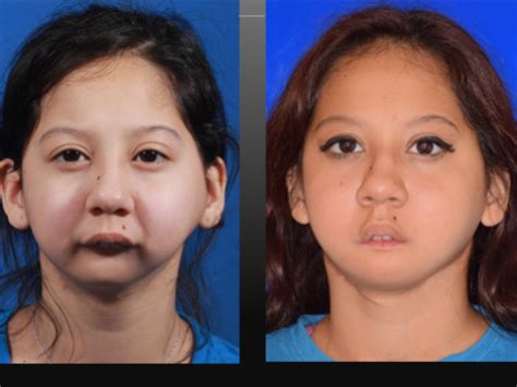 Texas Teen Born Without Jaw Benefits From New Surgery Wfmy News 2 Scoopnest