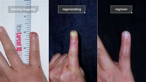how to heal a cut finger tip fast while leaving the cuts open might heal them try these home