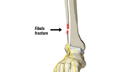 Fibula Fracture Types Symptoms Causes And Rehabilitation