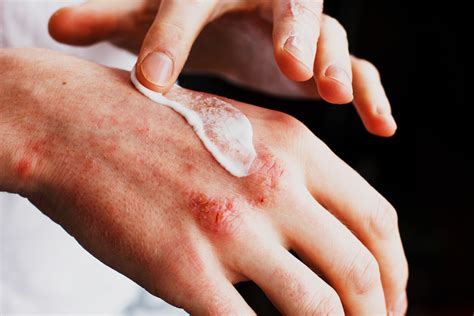 Neurodermatitis Eczema Symptoms Of The Skin Disease