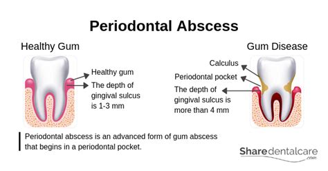 Dental Abscess Symptoms Causes And Treatment With Pictures