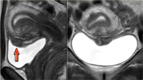 An overview of cochrane reviews. The Radiology Assistant : Endometriosis - MRI detection