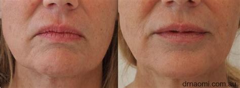 Lower Third Of Face Injections Best Clinic Sydney For