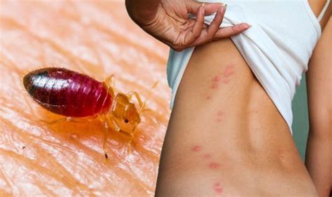 Bed Bugs Bites How Tell You Have Been Bitten Four Signs On Your Skin