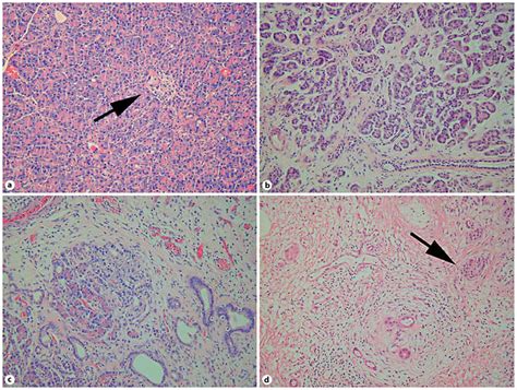 Histopathological Classification Of Pancreatic Fibrosis A Normal