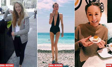 Anorexia Survivor 22 Shares Her Diary Of Daily Battle During