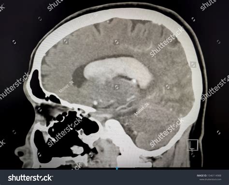 Image Ct Scan Showing Intraventricular Hemorrhage Foto Stock 1546114988