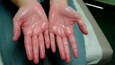 9 Home Remedies For Sweaty Hands And Feet №5 Is Sure Proofed
