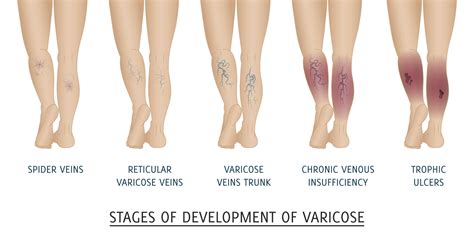 Best Essential Oils And Recipes For Varicose Veins Treatment