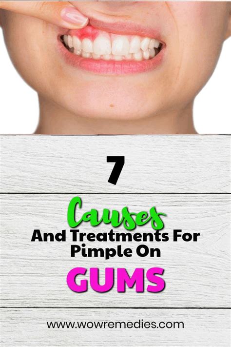 Pimple On Gums Causes Prevention And Treatment Pimples Gum Treatment