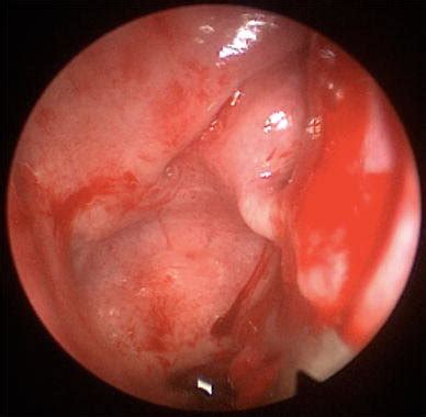 The upper and lower bony parts of the septum are formed by the perpendicular plate. Endoscopic view of the right nasal fossa showing lateral ...