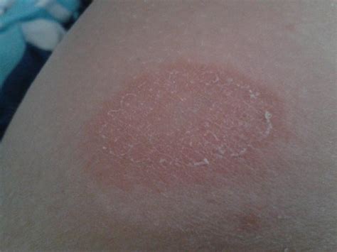 Häufig liegt der missempfindung eine nervenschädigung zugrunde. Hilfe! Ausschlage am Oberschenkel? (Gesundheit, Körper ...