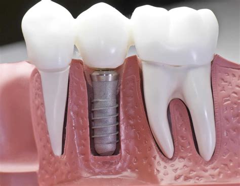 Conheça Os 3 Tipos De Implante Dentário Dr Adriano Assis