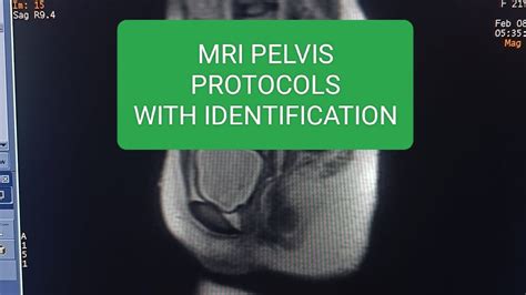 Mri Pelvis Protocols With Identification Mri Pelvis Protocoles Kese