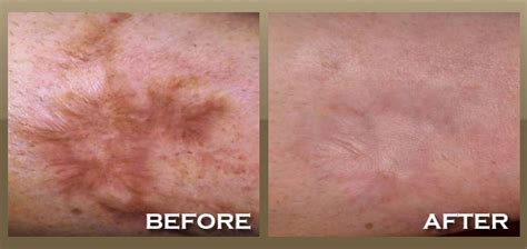 Eczema Scar Removal Dorothee Padraig South West Skin Health Care