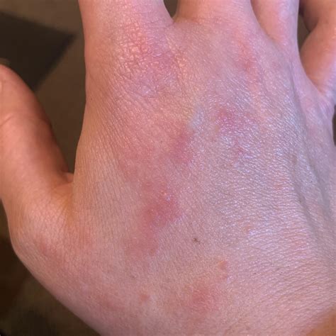 Hoping for help identifying this rash on my hand. It itches unless I
