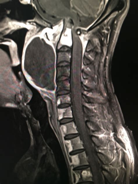 Potts Spine With Retro Pharyngeal Abscess Radiology Diagnostic