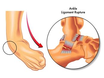 Here are some pointers to keep in. Mr Peter Ammon | Ankle Arthroscopy and Ankle Ligament ...