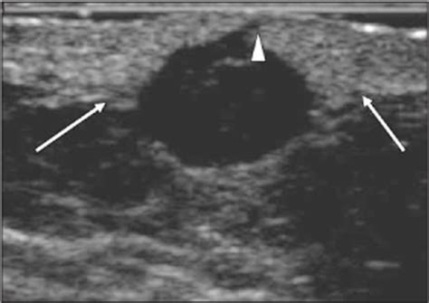 Carcinoma Of The Breast Mimicking An Areolar Dermal Lesion Glazebrook