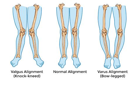 Osteoarthritis Of The Knee Can Result In Knock Knees Or Bowed Legs
