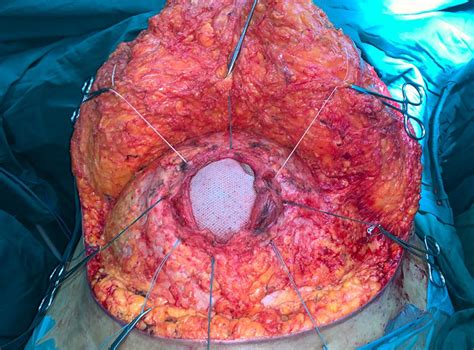 Giant Midline Abdominal Wall Hernias Case History Of 48 Year Old
