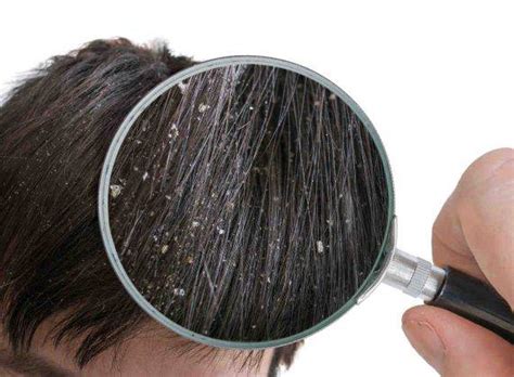 Croste sul cuoio capelluto: cause, sintomi e come rimediare
