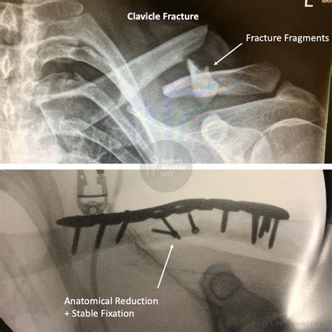 Broken Collarbone Surgery Shoulder Surgery Sydney Shoulder Unit