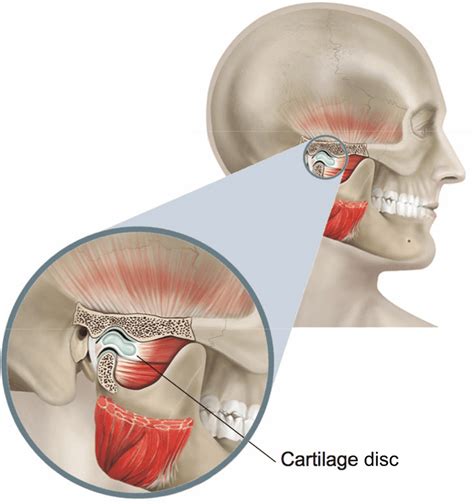 Tmj Arthroscopy Healthdirect