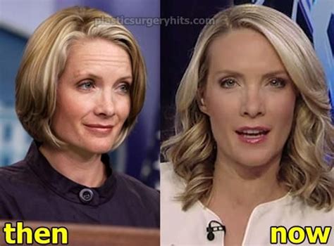 Dana Perino Plastic Surgery Before And After Dana Perino Plastic Surgery Dana