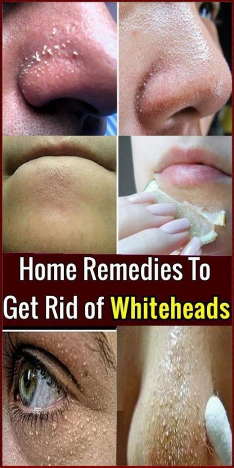 How To Get Rid Of Whiteheads Naturally At Home Oily Face Remedy