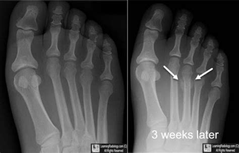 Mri Of Foot Stress Fracture