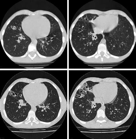 Read about the symptoms, causes and treatments. -Patient with cystic fibrosis with improvement of lung ...