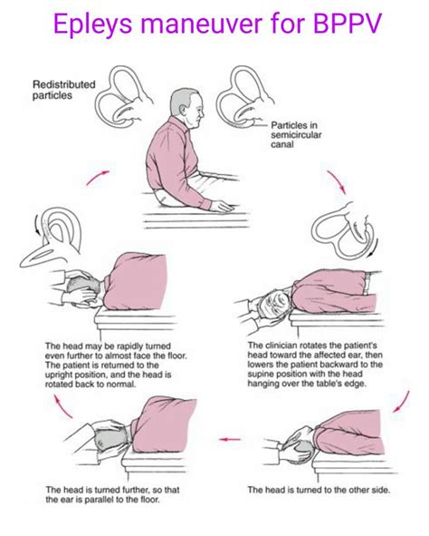 View Epley Manoeuvre For Bppv 