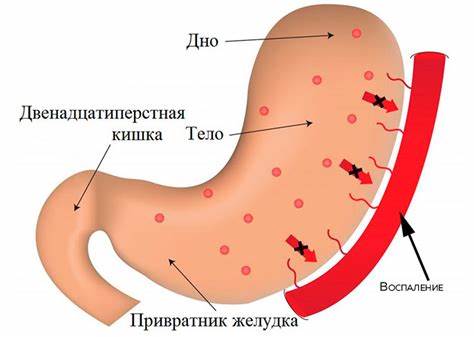Гастрит желудка симптомы диета Антральный эрозивный гастрит, симптомы и лечение, диета Антральный эрозивный гастрит, симптомы и лечение, диета Гастрит желудка симптомы диета