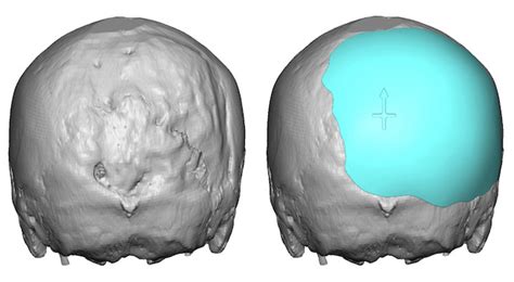 Plastic Surgery Case Study Custom Skull Implant For Right Occipital