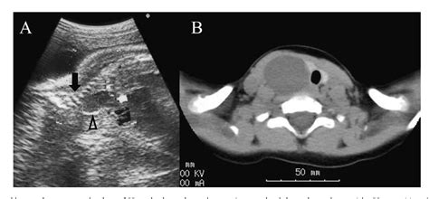 Figure 1 From A Right Sided Fourth Branchial Cleft Cyst A Case Report