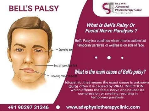 Bells Palsy Treatment Higgibt