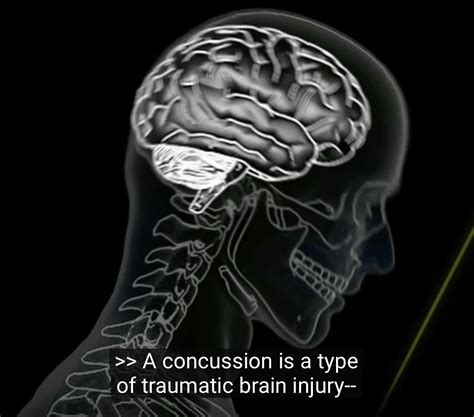 What Is A Concussion The Whole Psychiatry And Brain Recovery Center