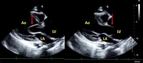 Transthoracic Echocardiography Parasternal Long Axis View Pedulum