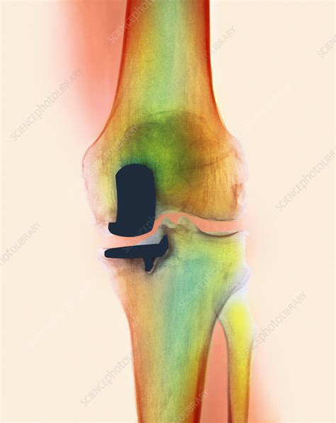 Knee Joint Prosthesis X Ray Stock Image M6000323 Science Photo